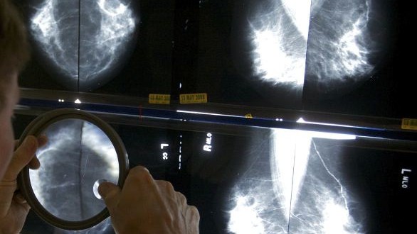 Risks of Breast Cancer Screening in Women 70-Plus, Report