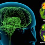 Schizophrenia is eight different diseases, not one : New Study