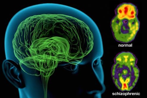 Schizophrenia is eight different diseases, not one : New Study