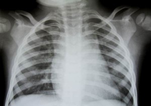 Texas: 700 infants exposed to TB at hospital
