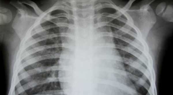 Texas 700 infants exposed to TB at hospital