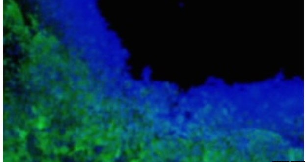 Researchers engineer toxin-secreting stem cells to treat brain tumors