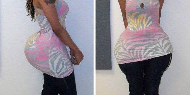 Glue in Buttocks Butt injection suspect Oneal Morris asks judge for bond