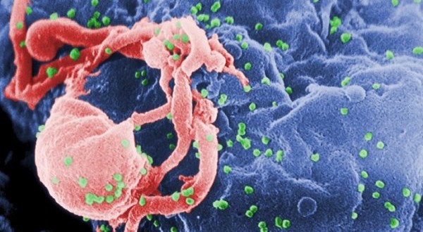 New HIV strain detected in Cuba, Develops Into AIDS Very Fast
