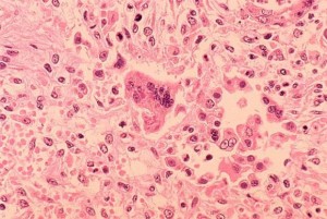 Sixth measles case confirmed in Niagara, official says