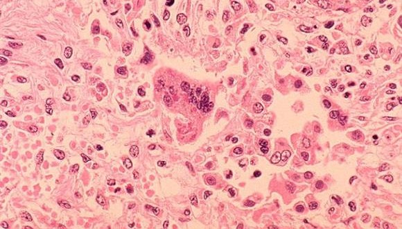 Sixth measles case confirmed in Niagara, official says