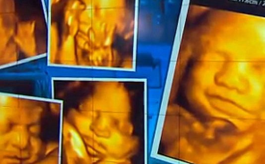 3-D Ultrasounds Could Be Dangerous, FDA : Study