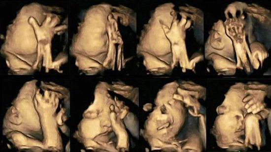 Smoking And Pregnancy : Ultrasound images reveal what smoking does to unborn babies