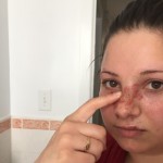 Nova Scotia woman recovering from burns after pizza slice assault