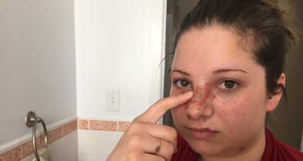 Nova Scotia woman recovering from burns after pizza slice assault