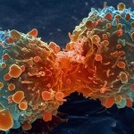 Canadian cancer cases will increase 40 per cent by 2030