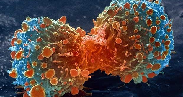 Canadian cancer cases will increase 40 per cent by 2030