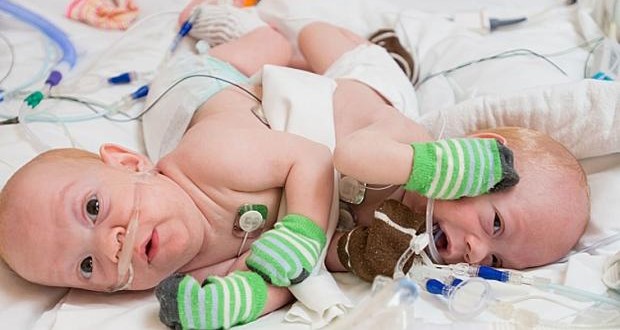 Conjoined twins separated in 12-hour operation (Video)