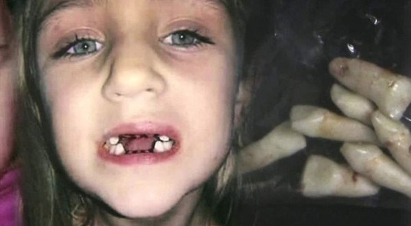 Dentist Accused Of Child Abuse : Took Out Teeth for No Reason (Video)