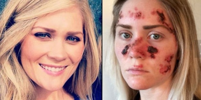 Tawny Willoughby : Woman's Skin Cancer Selfie Goes Viral