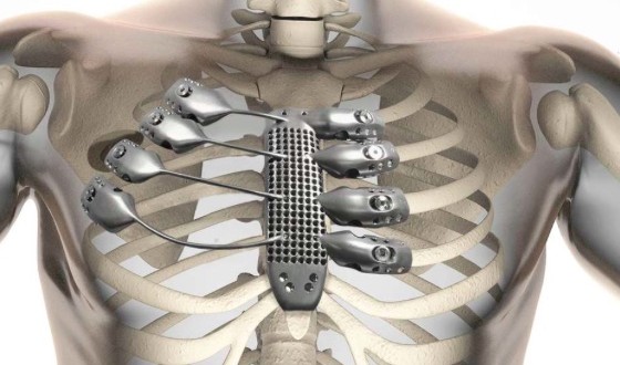 Spanish cancer patient receives world's first 3D-printed Titanium rib cage