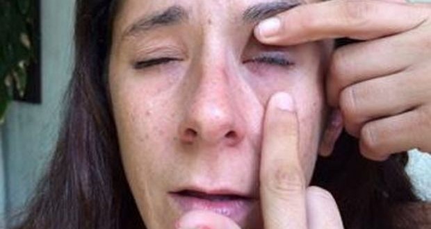 Woman glues eye shut after Visine, super glue mixup “Video”