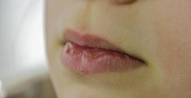 World Health Organization: Herpes affects two-thirds of people under 50