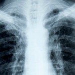Alberta study aims to catch lung cancer earlier