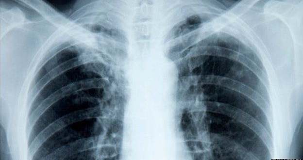 Alberta study aims to catch lung cancer earlier