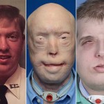 Patrick Hardison: Face Transplant Surgeons Make History And Change A Man's Life