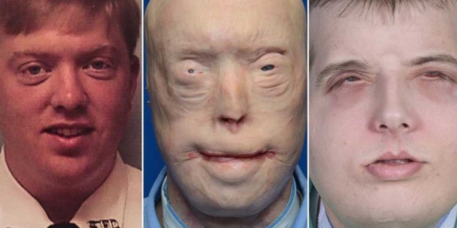 Patrick Hardison: Face Transplant Surgeons Make History And Change A Man’s Life “Video”