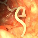 Tapeworm Cancer Develops Inside Colombian Man's Lungs, Killing Him after Diagnosis : CDC reports