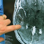 World First: Scientists break blood-brain barrier with focused ultrasound treatment