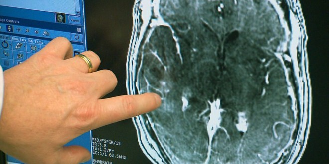 Canadian Doctors Breach the Blood-Brain Barrier