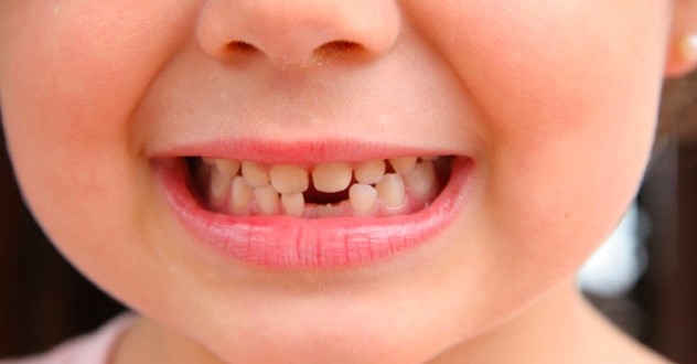 Research shows tooth decay worsened in Calgary children after fluoride removal