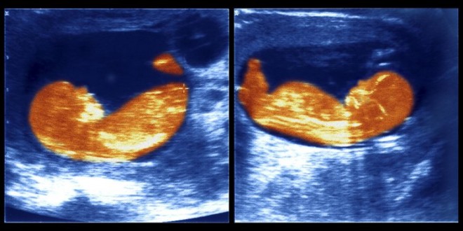 Twins with different fathers found in Vietnam, After DNA Testing