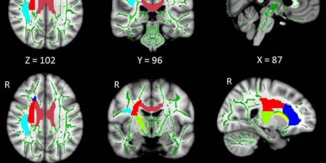 Insomnia Linked to Damage in Brain Communication Networks, New Study