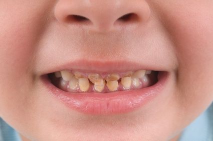 Tooth decay disease most common reason for day surgery on children, U of C study