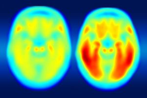 Research finds levels of tau protein better predicts Alzheimer's