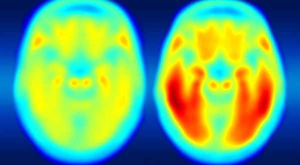 Research finds levels of tau protein better predicts Alzheimer’s