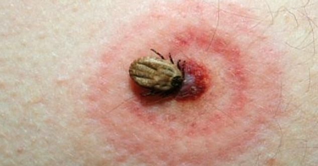 Risk Of Lyme Disease Low, Toronto Public Health says