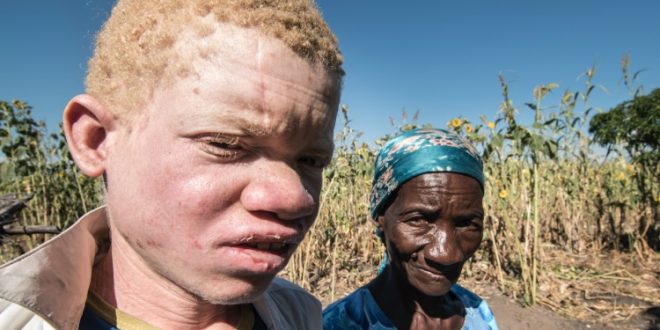 Malawi: Albino Deaths for Body Parts On the Rise, Report