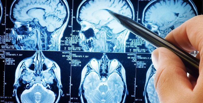 Alzheimer's New Drug could change millions of lives, Report