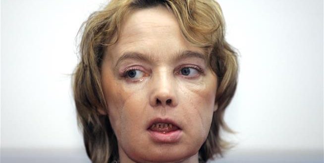Isabelle Dinoire: Woman who received first face transplant dies at 49