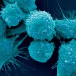 Prostate cancer scientists find genetic fingerprint identifying how; when disease spreads