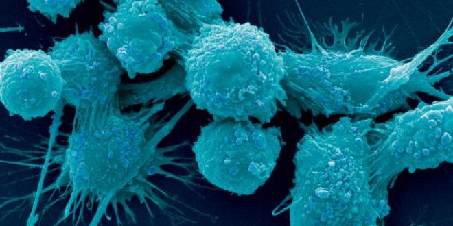 Prostate cancer scientists find genetic fingerprint identifying how; when disease spreads