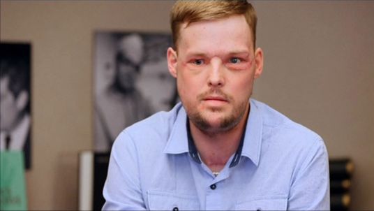 Face transplant helps Andy Sandness with second chance at life (Video)
