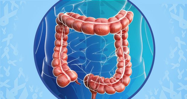 Colorectal cancer on the rise in millennials, says new study