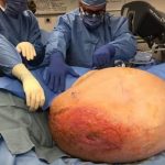 Mary Clancey has 140 pound malignant ovarian tumor removed