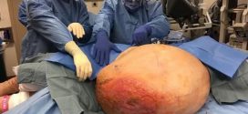 Mary Clancey has 140 pound malignant ovarian tumor removed