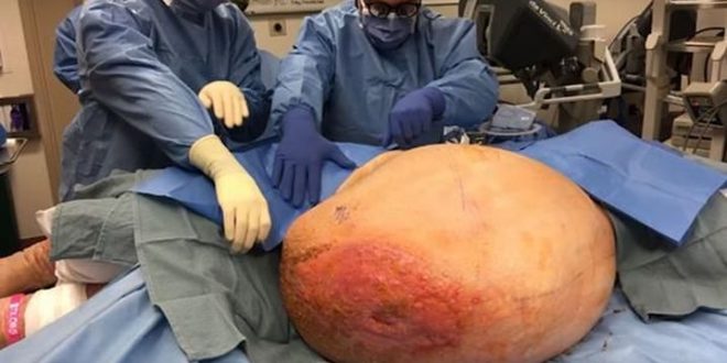 Mary Clancey has 140 pound malignant ovarian tumor removed