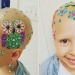 Young girl with alopecia dazzles on school's 'Crazy Hair Day' (Photo)
