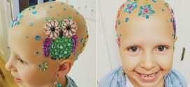 Young girl with alopecia dazzles on school's 'Crazy Hair Day' (Photo)
