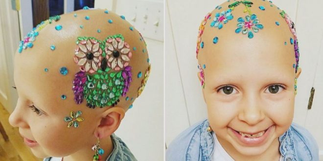 Young girl with alopecia dazzles on school’s ‘Crazy Hair Day’ (Photo)