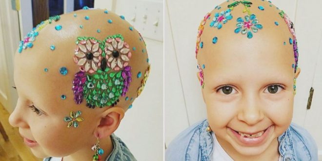 Young girl with alopecia dazzles on school's 'Crazy Hair Day' (Photo)